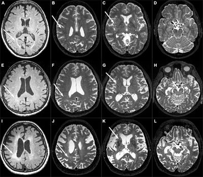Enlarged perivascular spaces and white matter hyperintensities in patients with frontotemporal lobar degeneration syndromes